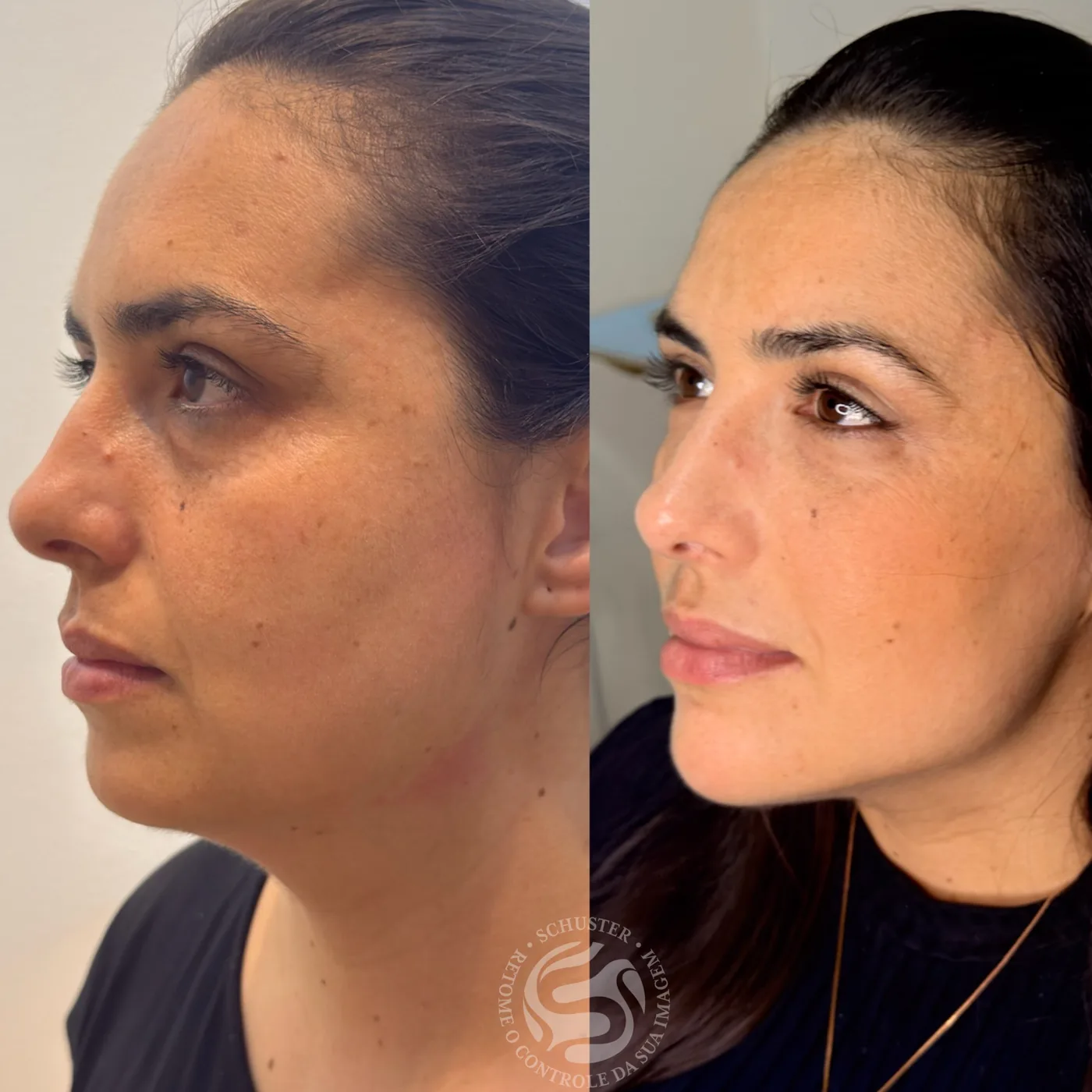 Antes e depois de uma paciente da Schuster Clinic, resultado 05